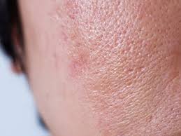 Acne prone