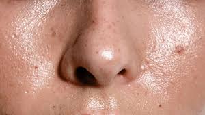 oily skin